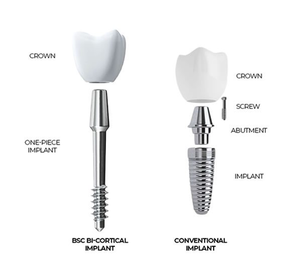 3-Day Immediate Implants