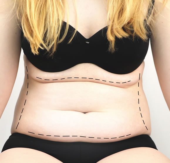 A tummy tuck can effectively address several common aesthetic concerns, including A tummy tuck can effectively address several common aesthetic concerns, including