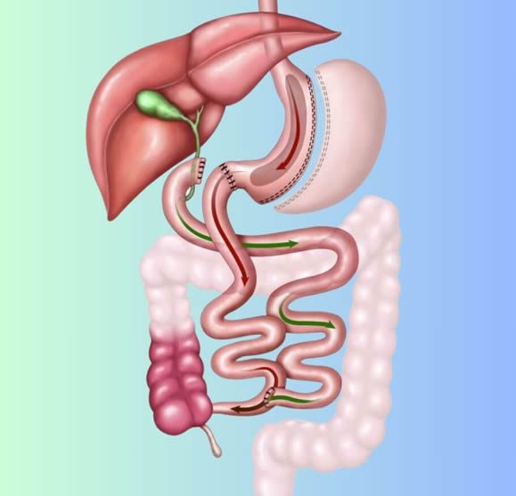 Duodenal Switch Operation – twthealth. com Duodenal Switch Operation - twthealth. com