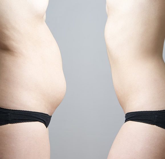 Types of Tummy Tuck Surgery Types of Tummy Tuck Surgery