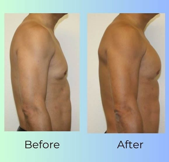 WHY PECTORAL IMPLANTS WHY PECTORAL IMPLANTS