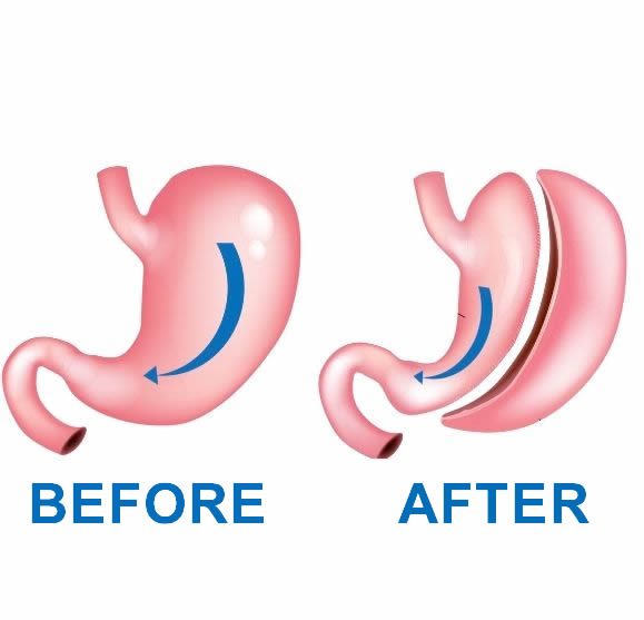 Who is Eligible for Gastric Sleeve