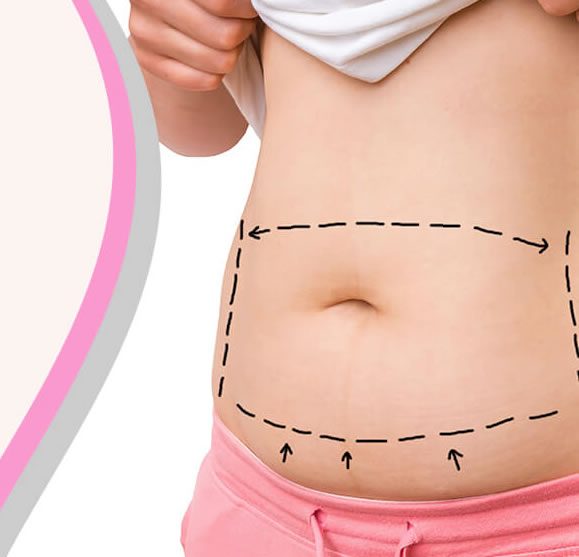 Who is Eligible for Tummy Tuck Surgery Who is Eligible for Tummy Tuck Surgery